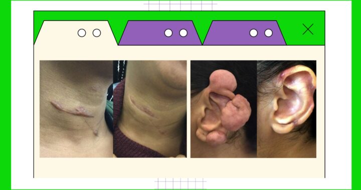 SKiN Stories: keloid removal surgery