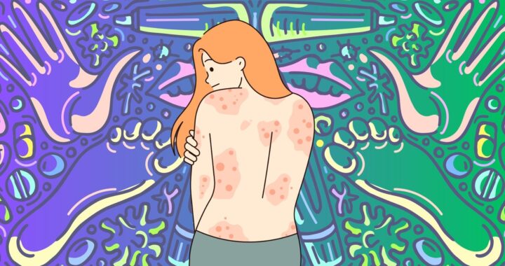 Think you know about: psoriasis