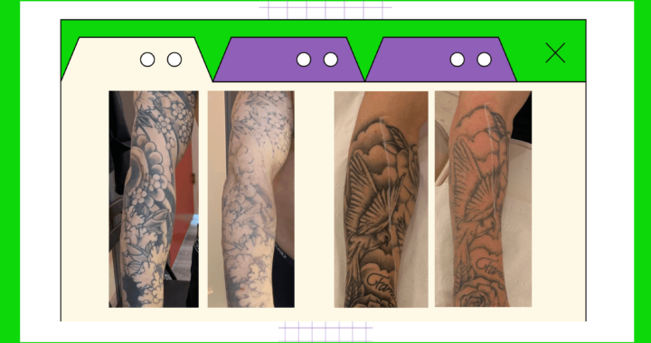 SKiN Stories: laser tattoo removal